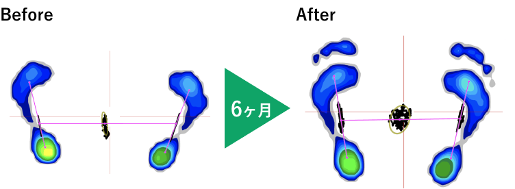 トレーニング前後の足圧の変化